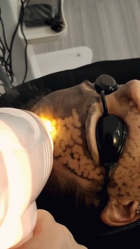 A cooling pass over the treated skin