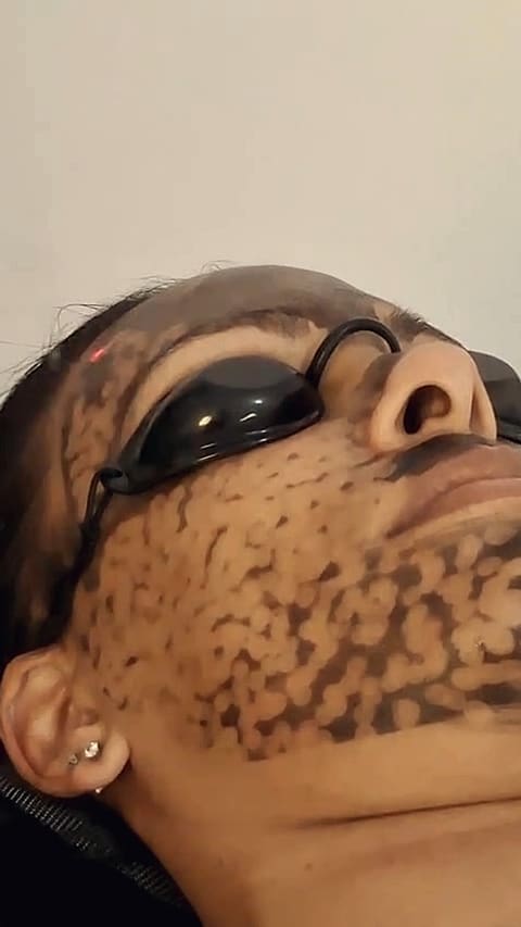 A carbon mask applied across a client’s face and jaw