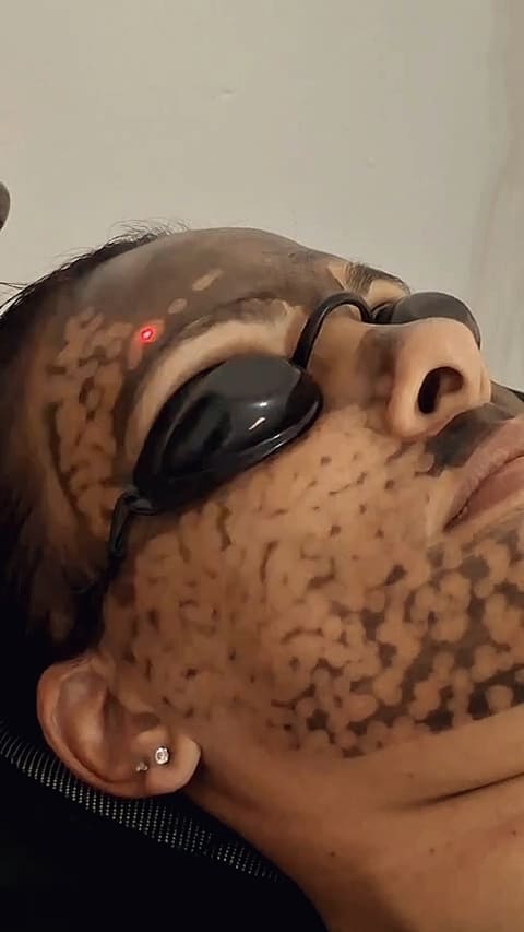 The laser handpiece passing over the carbon mask