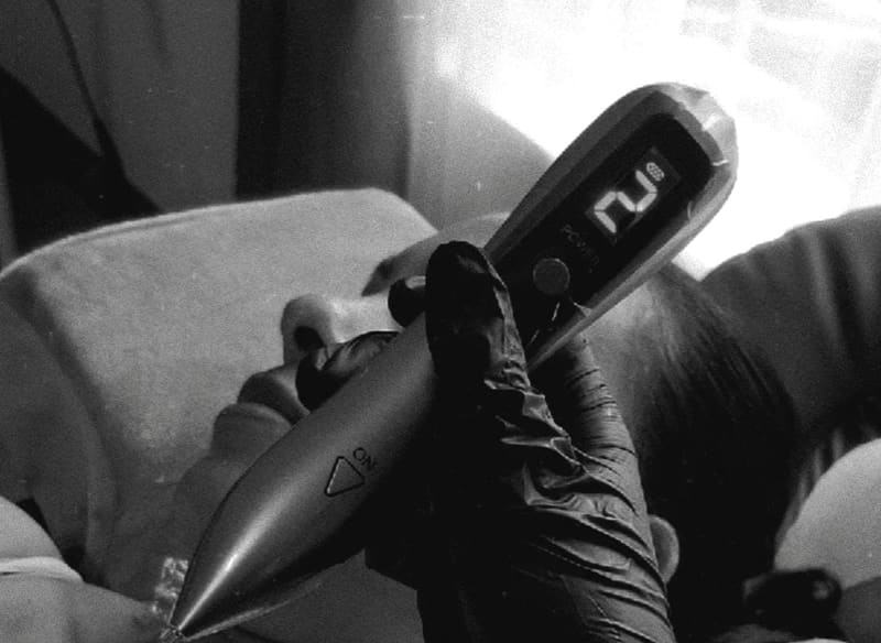 A plasma pen held ready for skin tag removal